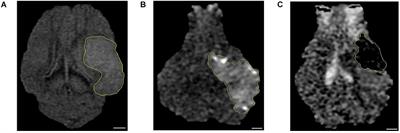 Dynamic Changes in the Gut Microbiome at the <mark class="highlighted">Acute Stage</mark> of Ischemic Stroke in a Pig Model
